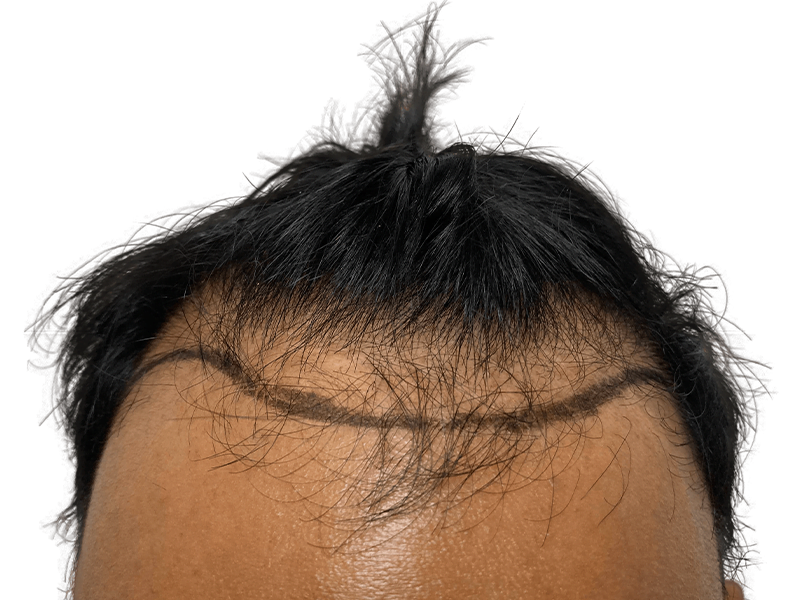 Hair transplant result: Asian male hairline with new growth. Before/after density visible. Hair restoration procedure.