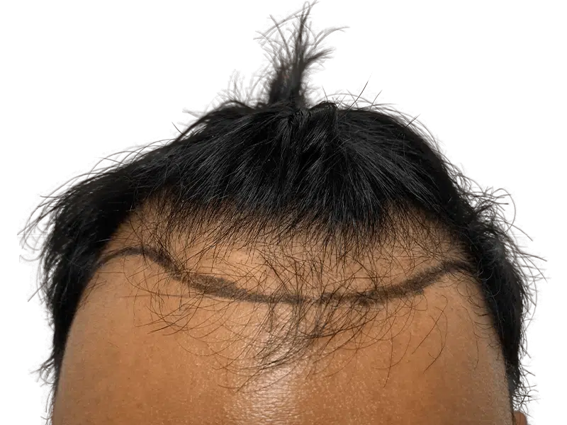 Hair transplant result: Asian male hairline with new growth. Before/after density visible. Hair restoration procedure.