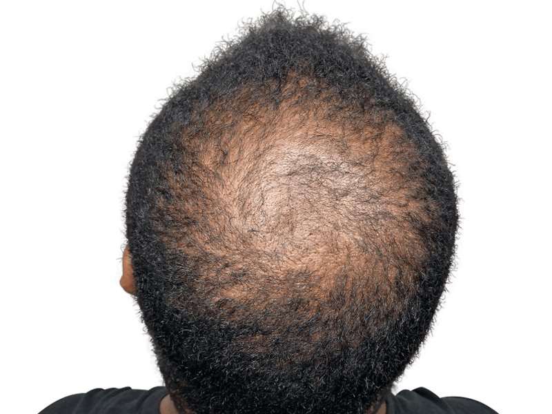 Hair loss in African American man. Thinning dark, curly hair on crown. Consider hair restoration or transplant options.