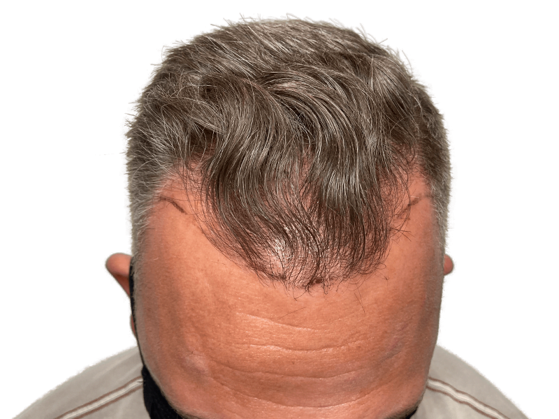 Hair transplant markings on receding hairline. Graying hair, Caucasian man. Hair restoration procedure planning/results.