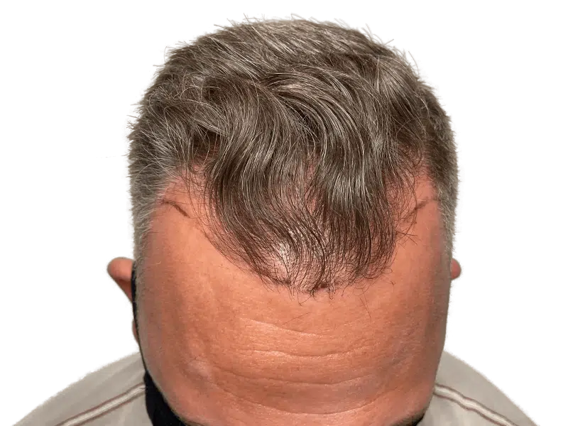 Hair transplant markings on receding hairline. Graying hair, Caucasian man. Hair restoration procedure planning/results.