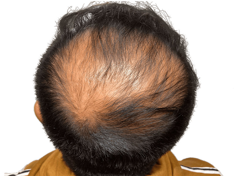 Significant hair loss. Candidate for hair restoration or transplant. Sparse hair on crown. Before treatment.