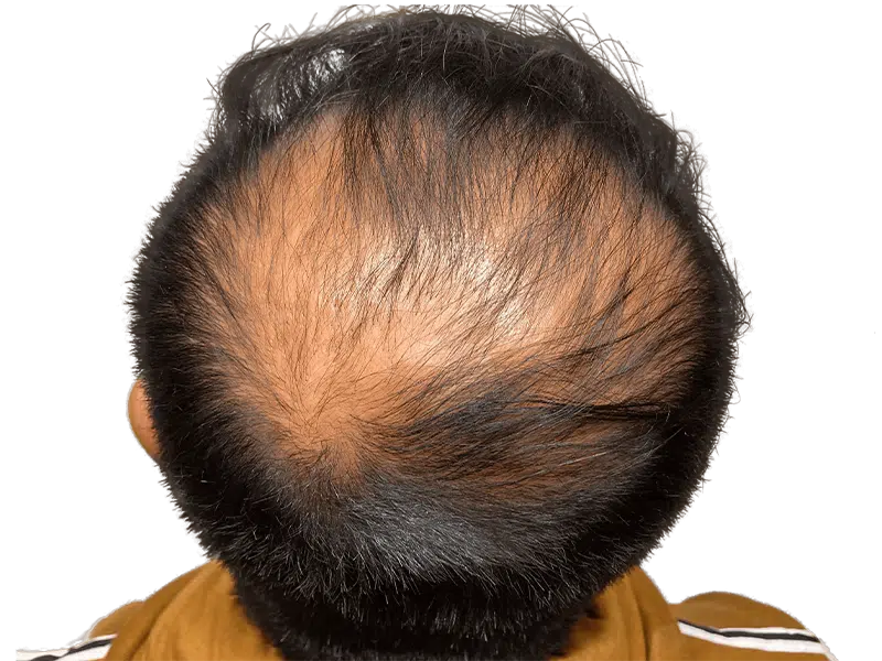 Significant hair loss. Candidate for hair restoration or transplant. Sparse hair on crown. Before treatment.