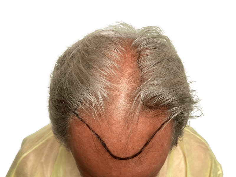 Before hair transplant: Thinning gray hair, receding hairline marked for restoration. Caucasian male.