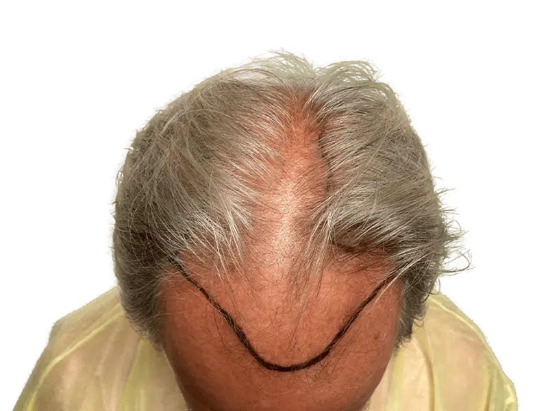 Before hair transplant: Thinning gray hair, receding hairline marked for restoration. Caucasian male.