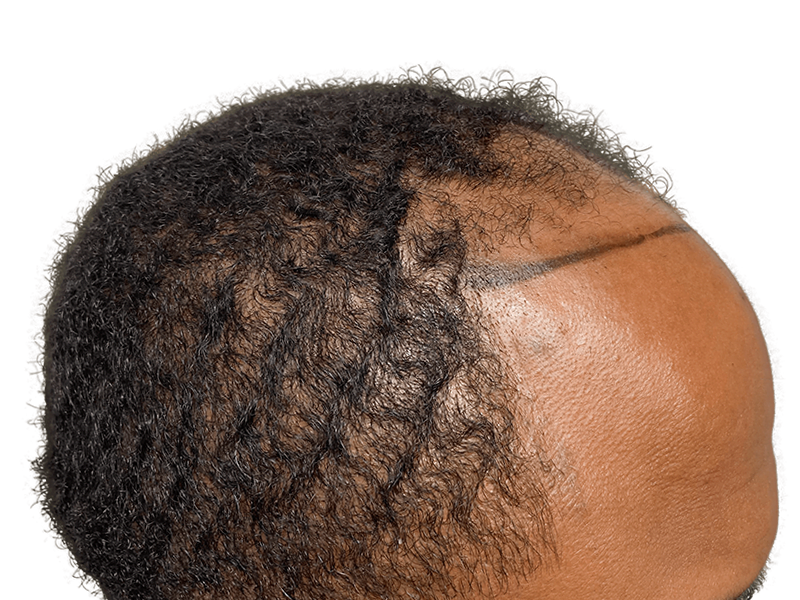 Hair transplant before & after on African American man. Shows hair restoration results and procedure area.