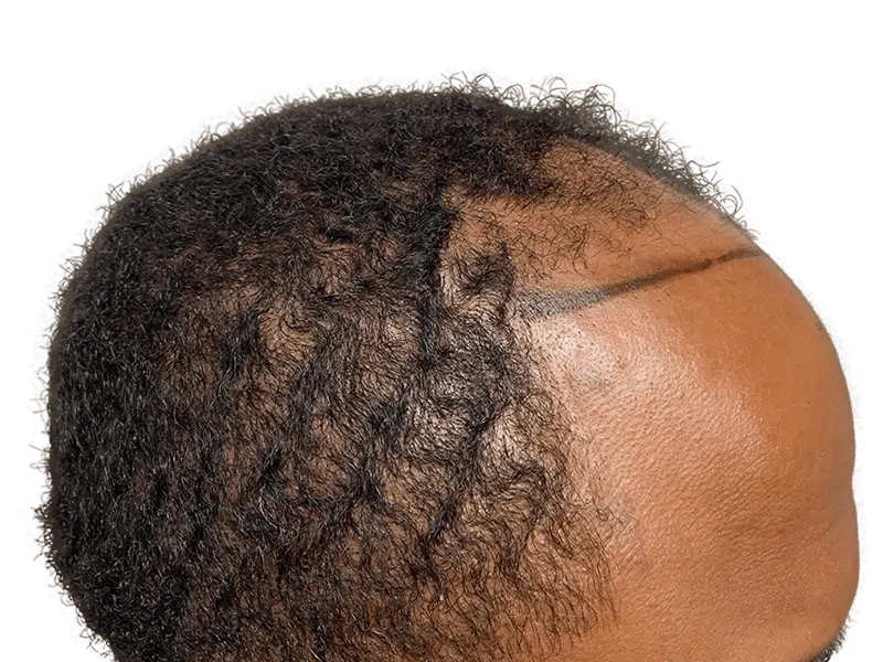 Hair transplant before & after on African American man. Shows hair restoration results and procedure area.