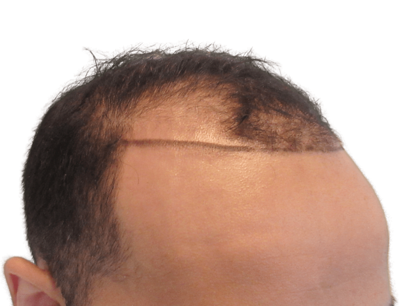 Hair transplant before & after: Fuller hairline achieved. Hair restoration results visible. Improved density.