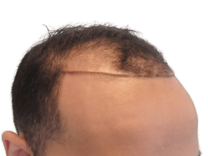 Hair transplant before & after: Fuller hairline achieved. Hair restoration results visible. Improved density.