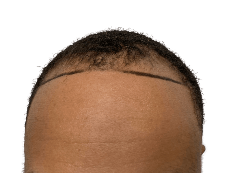 Before hair transplant: African American man's receding hairline marked for restoration. Hair loss treatment results.