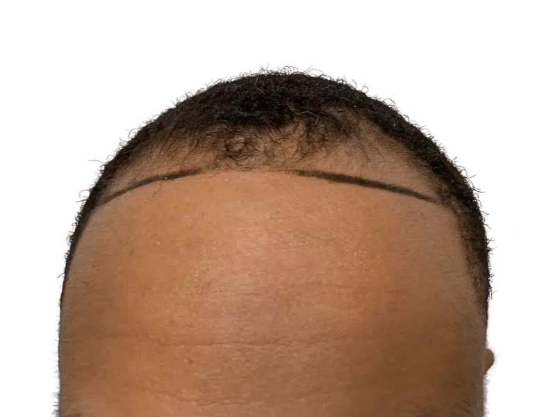 Before hair transplant: African American man's receding hairline marked for restoration. Hair loss treatment results.