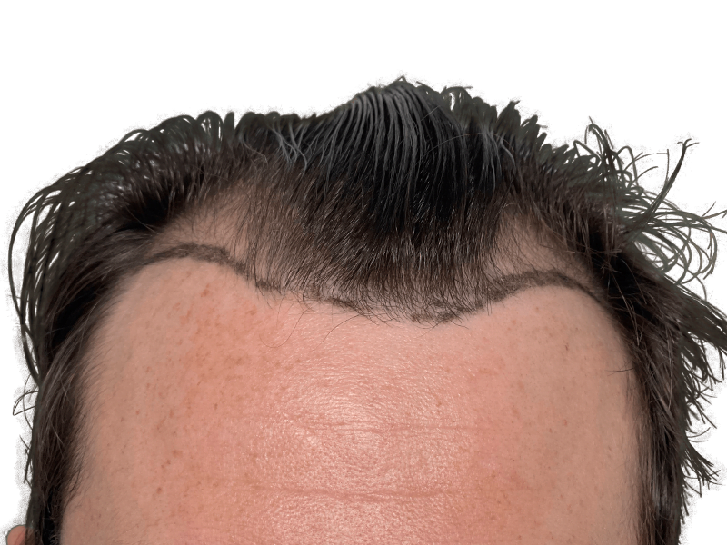 Hair transplant before: Marked receding hairline on fair skin. Hair restoration procedure planning.