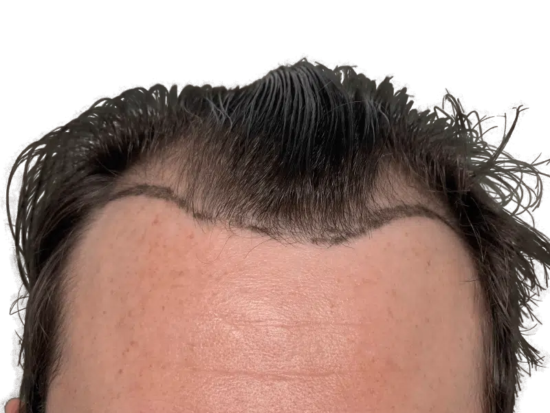 Hair transplant before: Marked receding hairline on fair skin. Hair restoration procedure planning.