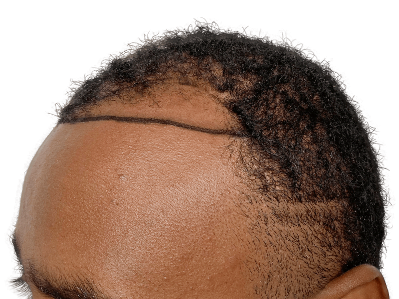 Hair transplant planning: African American man's receding hairline marked for restoration. Before hair transplant procedure.