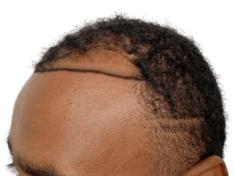 Hair transplant planning: African American man's receding hairline marked for restoration. Before hair transplant procedure.