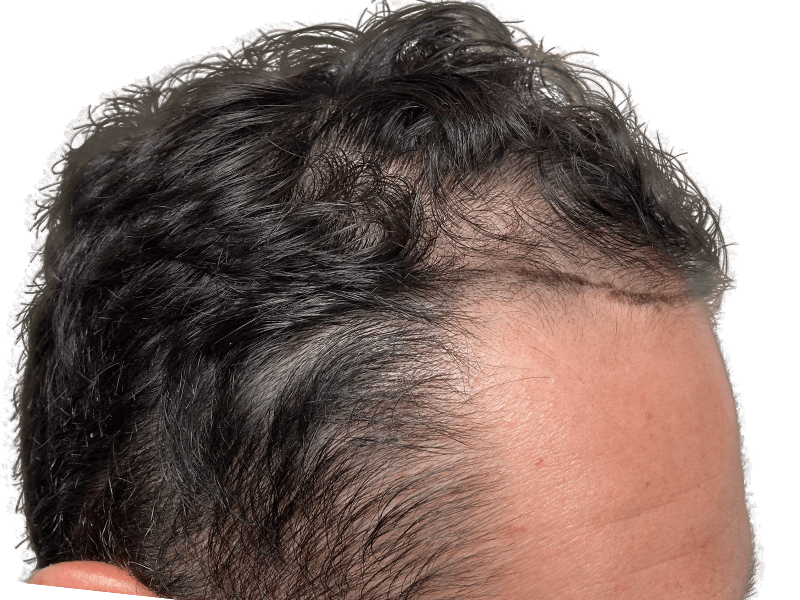 Hair transplant result: Improved hairline and density on Caucasian male. Before & after hair restoration procedure.