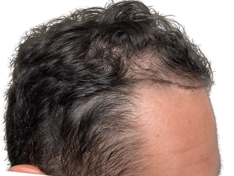 Hair transplant result: Improved hairline and density on Caucasian male. Before & after hair restoration procedure.
