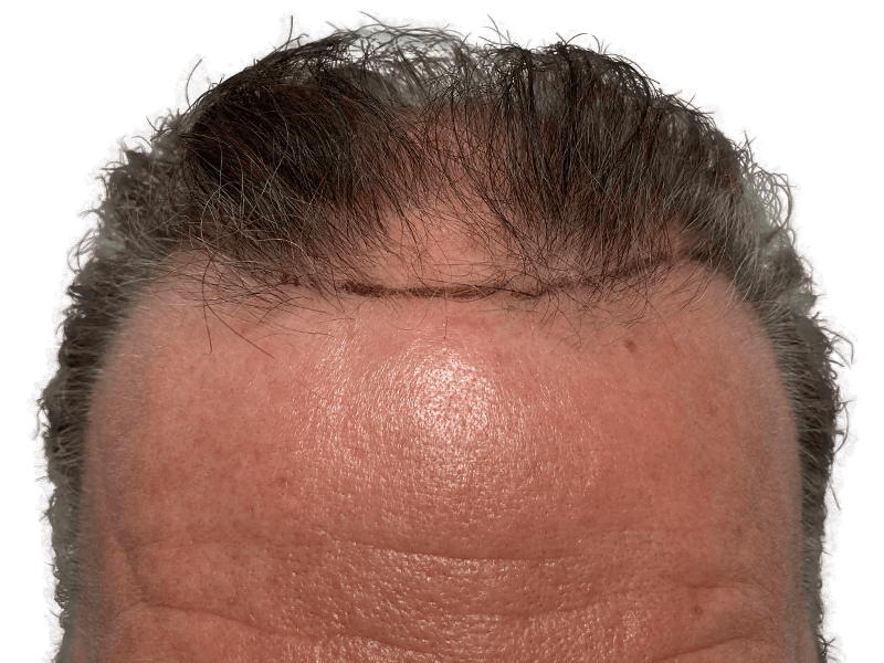 Hair transplant result: denser hairline achieved. Scar visible. Hair restoration success. Before & after transformation.