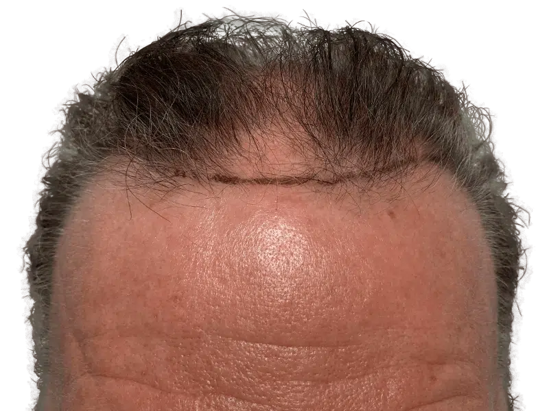 Hair transplant result: denser hairline achieved. Scar visible. Hair restoration success. Before & after transformation.
