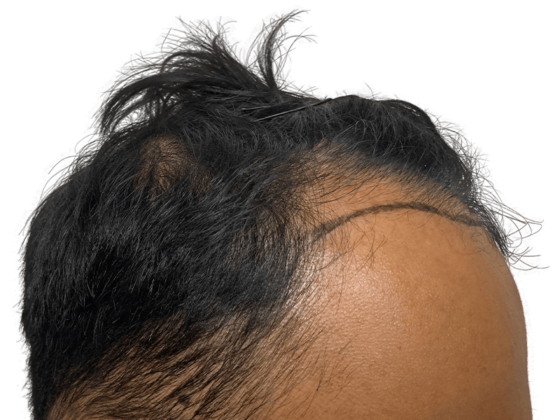 Receding hairline marked for hair transplant. Before photo showcasing hair restoration needs. Dark hair, African American/Hispanic.