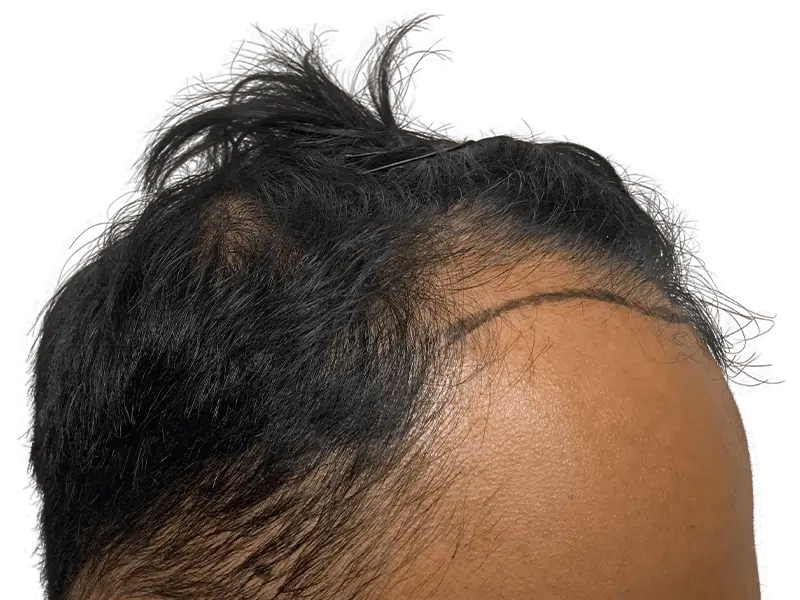 Receding hairline marked for hair transplant. Before photo showcasing hair restoration needs. Dark hair, African American/Hispanic.