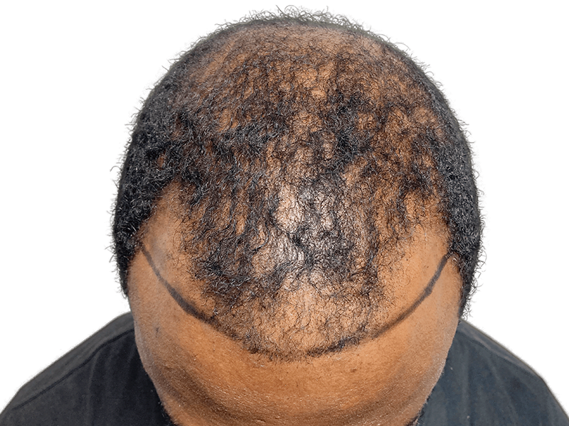 Hair transplant planning: African American man with thinning hair marked for hairline restoration. Before procedure.