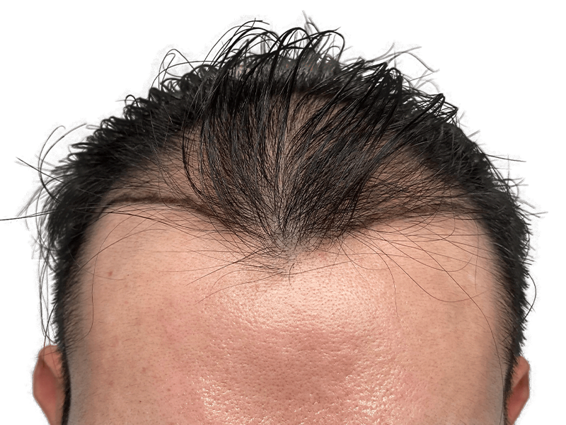 Receding hairline. Before hair restoration treatment. Dark hair thinning at temples. Hair transplant consultation image.