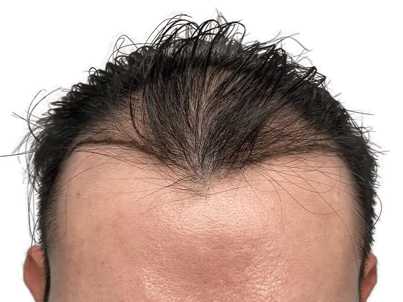 Receding hairline. Before hair restoration treatment. Dark hair thinning at temples. Hair transplant consultation image.