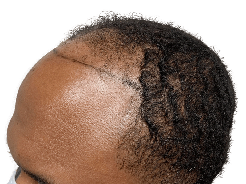Hair transplant result: African American man's hairline restored. Before & after hair restoration procedure.