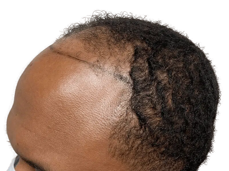 Hair transplant result: African American man's hairline restored. Before & after hair restoration procedure.