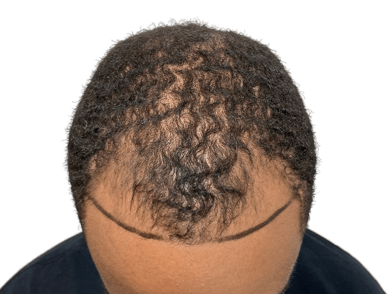 Hair transplant consultation: African American man with thinning hair. Marked hairline for planned restoration. Before photo.