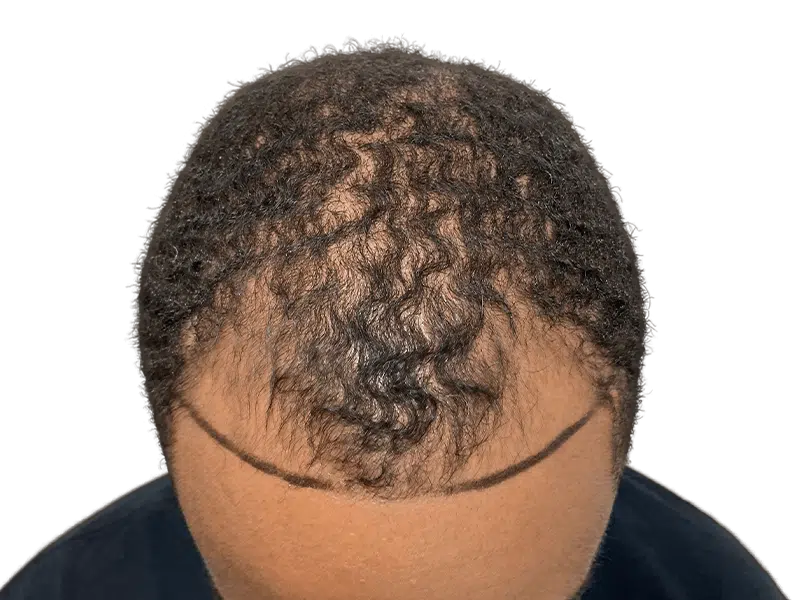 Hair transplant consultation: African American man with thinning hair. Marked hairline for planned restoration. Before photo.
