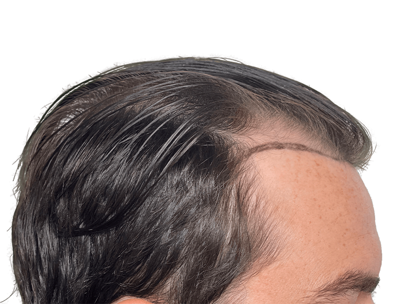 Hair transplant hairline close-up. Dark hair, light skin. Noticeable density difference. Hair restoration result.