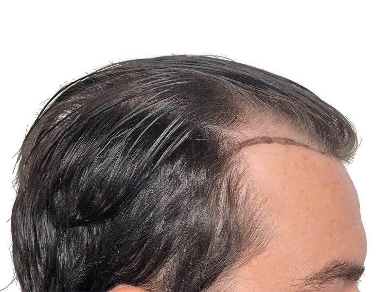 Hair transplant hairline close-up. Dark hair, light skin. Noticeable density difference. Hair restoration result.