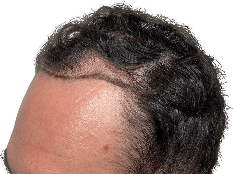 Hair transplant result: Close-up of Caucasian hairline showing restored hair. Hair restoration procedure success.