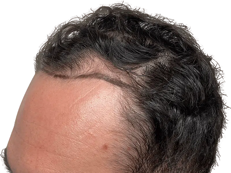 Hair transplant result: Close-up of Caucasian hairline showing restored hair. Hair restoration procedure success.