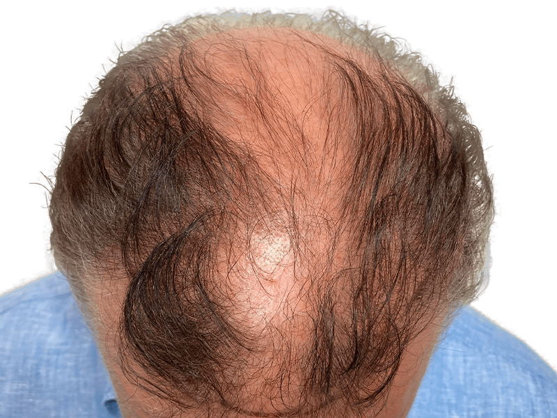 Man's thinning hair before restoration. Shows balding crown & frontal areas. Hair transplant candidate.