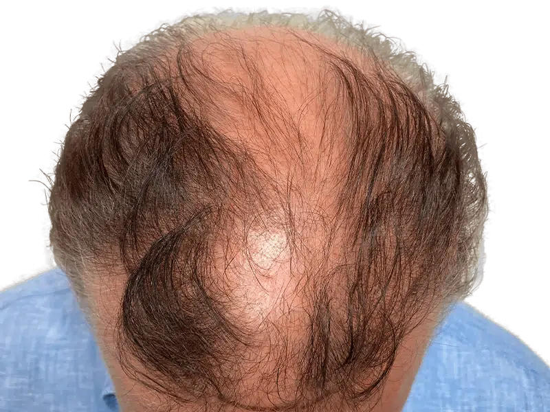 Man's thinning hair before restoration. Shows balding crown & frontal areas. Hair transplant candidate.