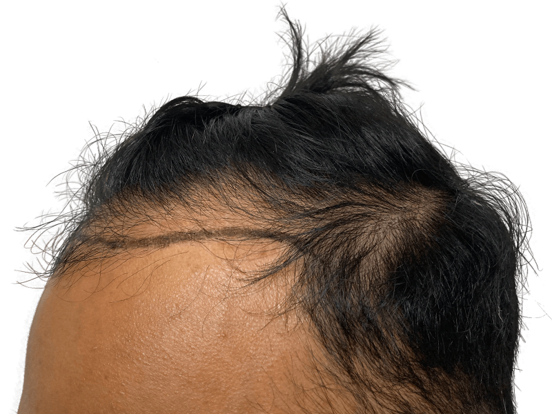 Hair transplant planning: Marked hairline on forehead shows proposed restoration. Thinning hair visible before procedure.