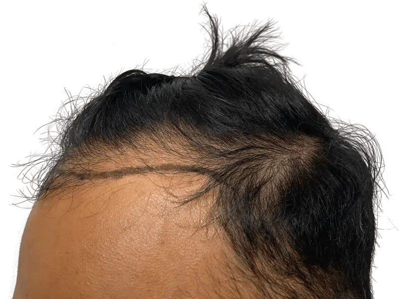 Hair transplant planning: Marked hairline on forehead shows proposed restoration. Thinning hair visible before procedure.