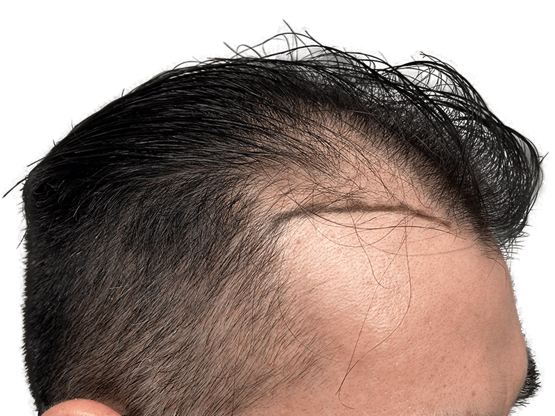 Hair transplant result: Receding hairline restored. Before & after showcasing improved density and natural-looking hairline.