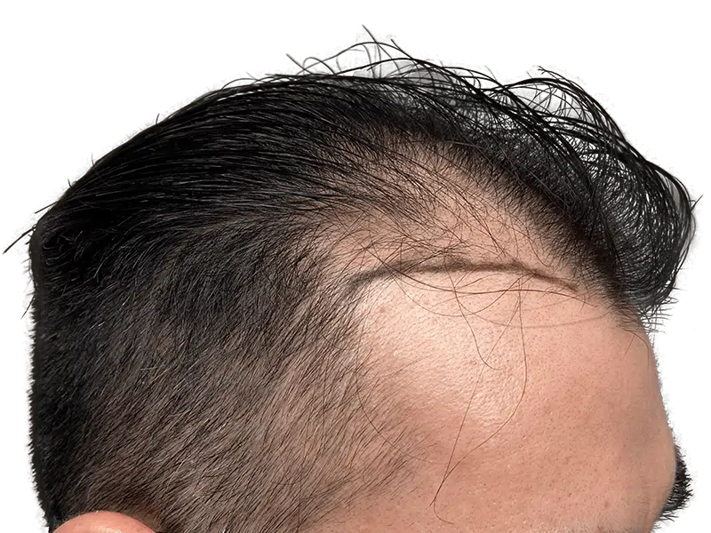 Hair transplant result: Receding hairline restored. Before & after showcasing improved density and natural-looking hairline.