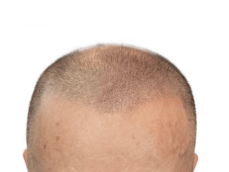 Before hair transplant: Receding hairline and thinning hair on a Caucasian man. Hair restoration candidate.
