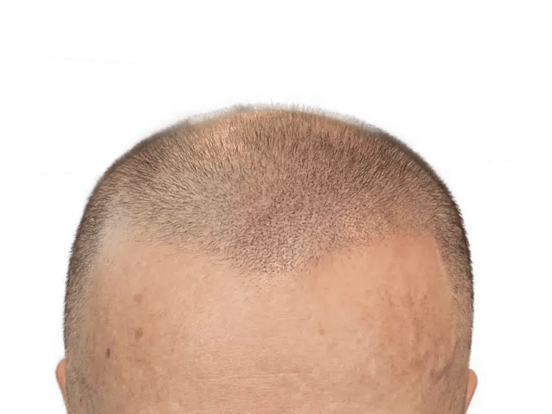Before hair transplant: Receding hairline and thinning hair on a Caucasian man. Hair restoration candidate.