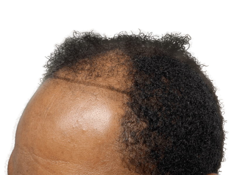 Hair transplant before & after: African American man with restored hairline. See the difference hair restoration can make!