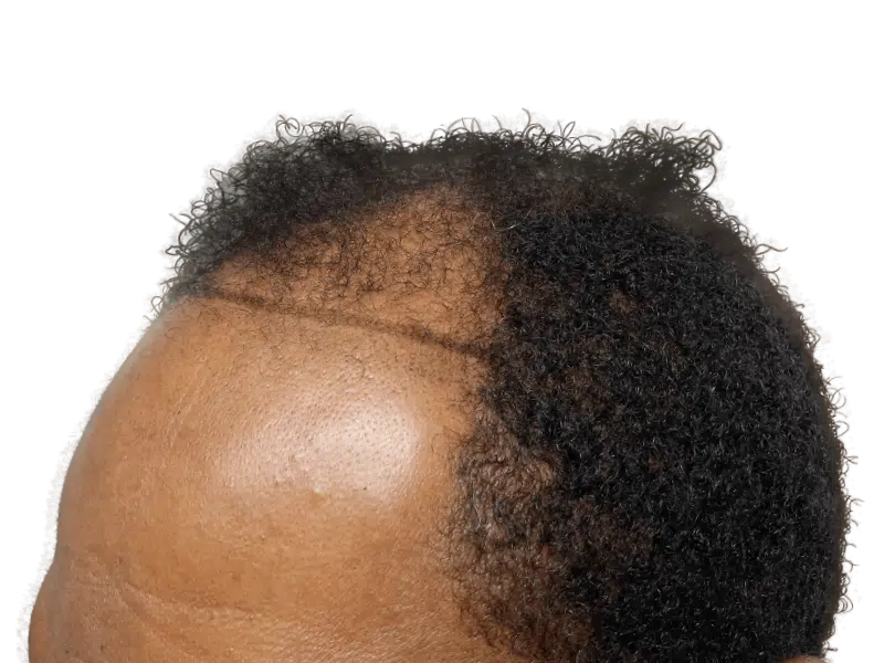 Hair transplant before & after: African American man with restored hairline. See the difference hair restoration can make!
