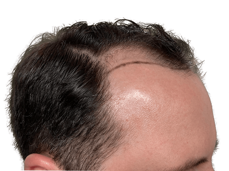 Hair transplant result: Man's hairline showing improved density after hair restoration procedure. Before & after example.