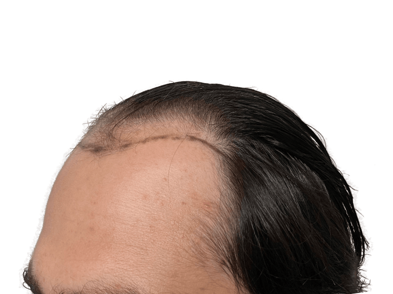 Hair transplant result: Close-up of hairline showing transplant scar. Dark hair, natural skin texture. Hair restoration procedure.