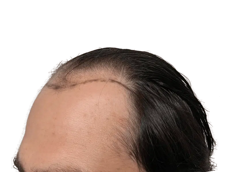 Hair transplant result: Close-up of hairline showing transplant scar. Dark hair, natural skin texture. Hair restoration procedure.