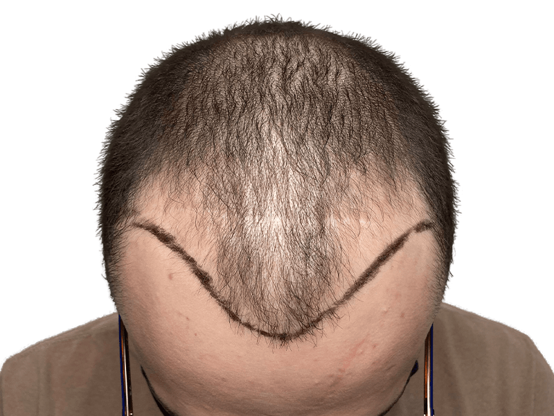 Before hair transplant: Thinning hair, receding hairline marked for restoration. Hair restoration procedure planning.